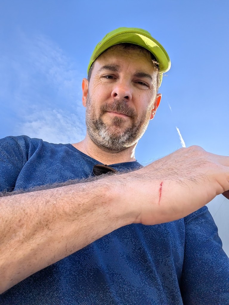 A white man wearing a blue shirt and a yellow hat shows a minor scratch on his outer wrist